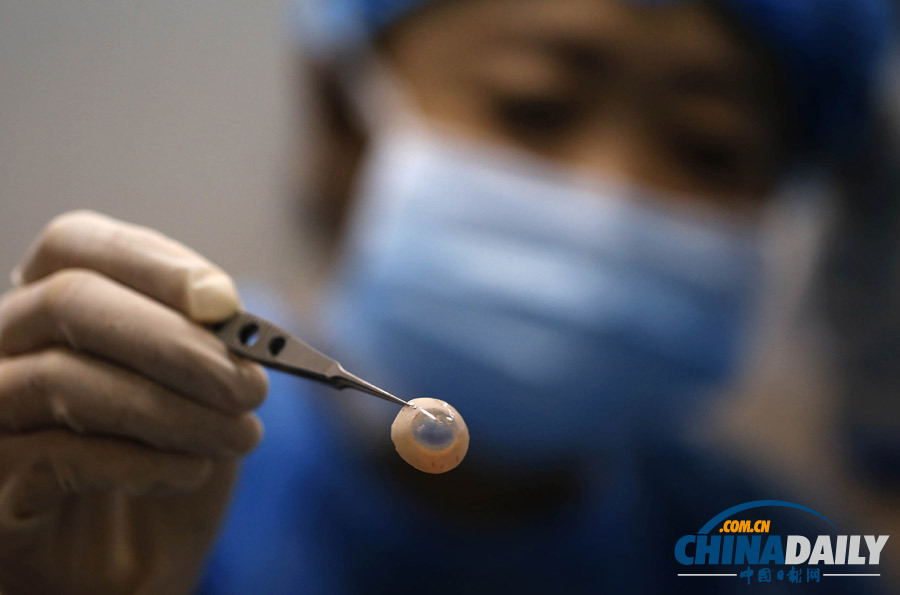 失明患者獲異國角膜“點亮”右眼 捐贈者車禍過世